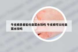 牛皮癬患者能吃韭菜水餃嗎 牛皮癬可以吃韭菜水餃嗎