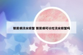 銀屑病淡水螃蟹 銀屑病可以吃淡水螃蟹嗎