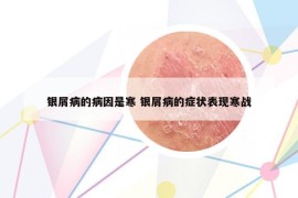 銀屑病的病因是寒 銀屑病的癥狀表現(xiàn)寒戰(zhàn)