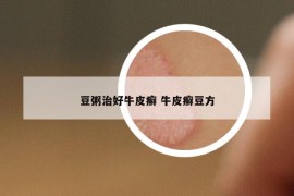 豆粥治好牛皮癬 牛皮癬豆方