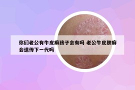 你們老公有牛皮癬孩子會(huì)有嗎 老公牛皮膚癬會(huì)遺傳下一代嗎