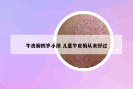 牛皮癬四歲小孩 兒童牛皮癬從未好過