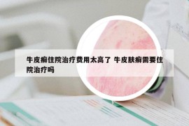 牛皮癬住院治療費(fèi)用太高了 牛皮膚癬需要住院治療嗎