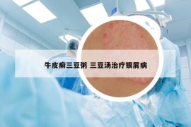 牛皮癬三豆粥 三豆湯治療銀屑病