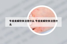 牛皮皮癬飲食注意什么 牛皮皮癬飲食注意什么