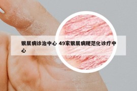 銀屑病診治中心 49家銀屑病規(guī)范化診療中心