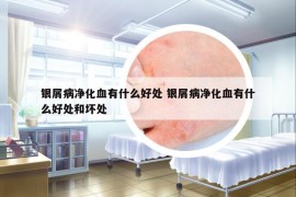 銀屑病凈化血有什么好處 銀屑病凈化血有什么好處和壞處