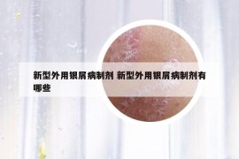 新型外用銀屑病制劑 新型外用銀屑病制劑有哪些