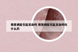 銀屑病能引起貧血嗎 銀屑病能引起貧血嗎吃什么藥