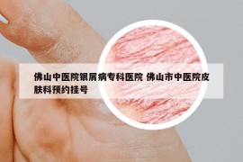 佛山中醫(yī)院銀屑病?？漆t(yī)院 佛山市中醫(yī)院皮膚科預約掛號