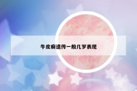 牛皮癬遺傳一般幾歲表現(xiàn)
