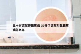 三十歲突然得銀屑病 30多了突然引起銀屑病怎么辦