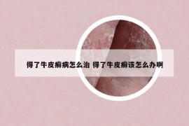 得了牛皮癬病怎么治 得了牛皮癬該怎么辦啊