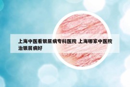 上海中醫(yī)看銀屑病專科醫(yī)院 上海哪家中醫(yī)院治銀屑病好