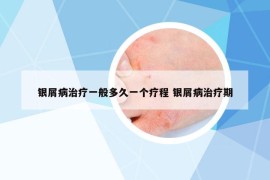 銀屑病治療一般多久一個療程 銀屑病治療期