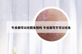 牛皮癬可以吃鱈魚膠嗎 牛皮癬可不可以吃魚