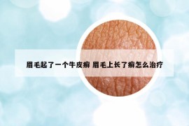 眉毛起了一個(gè)牛皮癬 眉毛上長了癬怎么治療
