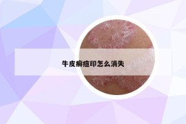 牛皮癬痘印怎么消失