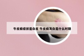 牛皮癬癥狀是白皮 牛皮癬發(fā)白是什么時期