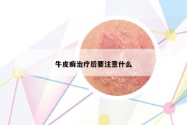 牛皮癬治療后要注意什么