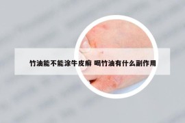 竹油能不能涂牛皮癬 喝竹油有什么副作用