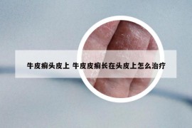 牛皮癬頭皮上 牛皮皮癬長在頭皮上怎么治療