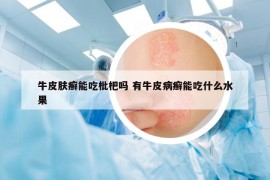 牛皮膚癬能吃枇杷嗎 有牛皮病癬能吃什么水果