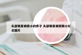 頭部銀屑病很小的疹子 頭部銀屑病初期小紅點圖片