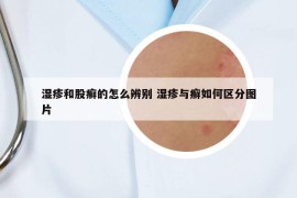 濕疹和股癬的怎么辨別 濕疹與癬如何區(qū)分圖片