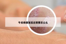 牛皮癬康復(fù)后還需要忌口么