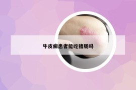 牛皮癬患者能吃豬腸嗎