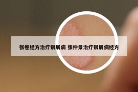 張卷經(jīng)方治療銀屑病 張仲景治療銀屑病經(jīng)方