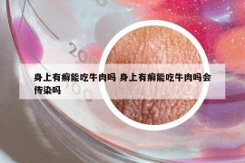 身上有癬能吃牛肉嗎 身上有癬能吃牛肉嗎會傳染嗎