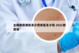 全國銀屑病有多少費用是多少錢 2021銀屑病