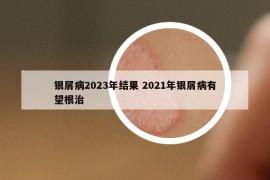 銀屑病2023年結果 2021年銀屑病有望根治