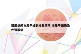 銀屑病間充質(zhì)干細(xì)胞湘雅醫(yī)院 湘雅干細(xì)胞治療銀屑病