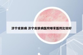 濟(jì)寧皮膚病 濟(jì)寧皮膚病醫(yī)院哪家醫(yī)院比較好