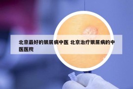 北京最好的銀屑病中醫(yī) 北京治療銀屑病的中醫(yī)醫(yī)院