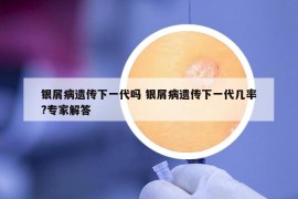 銀屑病遺傳下一代嗎 銀屑病遺傳下一代幾率?專(zhuān)家解答