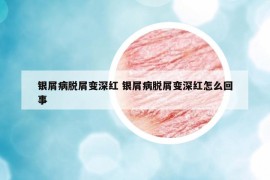 銀屑病脫屑變深紅 銀屑病脫屑變深紅怎么回事