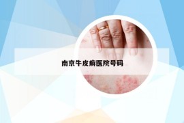 南京牛皮癬醫(yī)院號(hào)碼