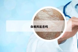 白癜風(fēng)能愈嗎
