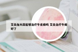 艾灸加大蒜能夠治療牛皮癬嗎 艾灸治療牛癬好了