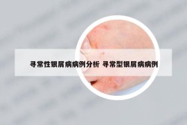 尋常性銀屑病病例分析 尋常型銀屑病病例
