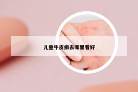 兒童牛皮癬去哪里看好
