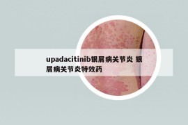upadacitinib銀屑病關(guān)節(jié)炎 銀屑病關(guān)節(jié)炎特效藥