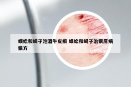 蜈蚣和蝎子泡酒牛皮癬 蜈蚣和蝎子治銀屑病偏方