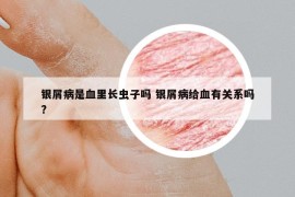 銀屑病是血里長(zhǎng)蟲(chóng)子嗎 銀屑病給血有關(guān)系嗎?