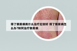 得了銀屑病用什么治療比較好 得了銀屑病怎么辦?如何治療銀屑病