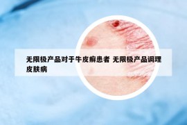 無限極產(chǎn)品對于牛皮癬患者 無限極產(chǎn)品調(diào)理皮膚病